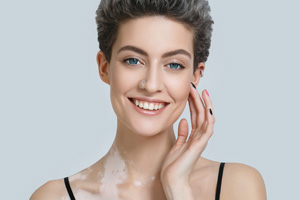 Vitiligo